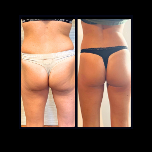 Golden RF Buttocks Before and After