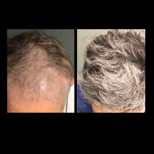 Hair Rejuvenation Before and After