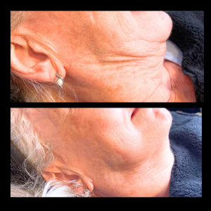 Golden RF Neck Before and After