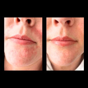 Dermalux Problem Skin