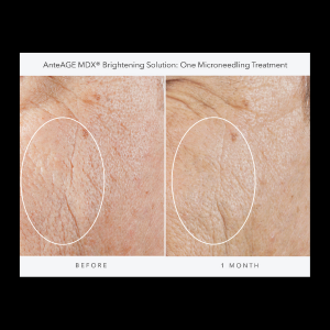 Exosomes Ante Age Brightening Solution Before and After