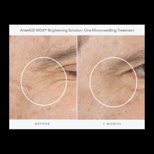 Exosomes Ante Age Brightening Solution Before and After