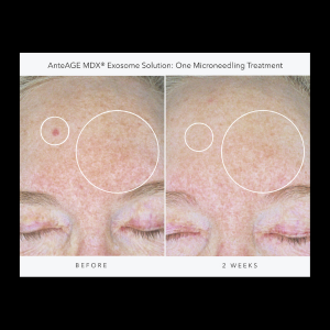 Exosomes Ante Age Solution Before and After