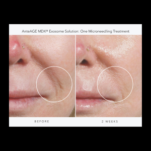 Exosomes Ante Age Solution Before and After