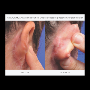 Exosomes Ante Age Solution Before and After
