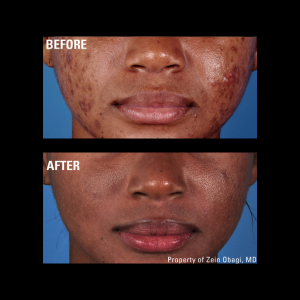zo skin health Acne before and after