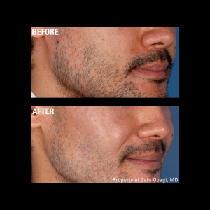 zo skin health Rosacea before and after