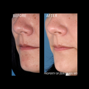 zo skin health Rosacea before and after