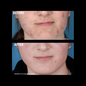 zo skin health Acne before and after