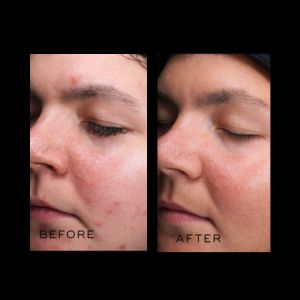 Chemical peel 7